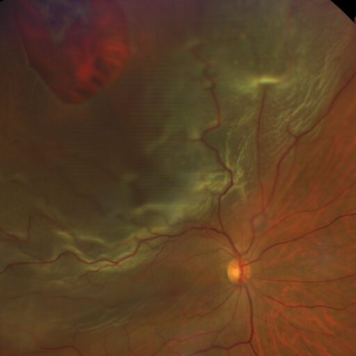 Imagem de fundo de olho mostrando descolamento de retina com elevação da retina neurossensorial. Exame ilustrativo do Dr. Paulo Oliveira, especialista em retina e vítreo em Goiânia (GO)