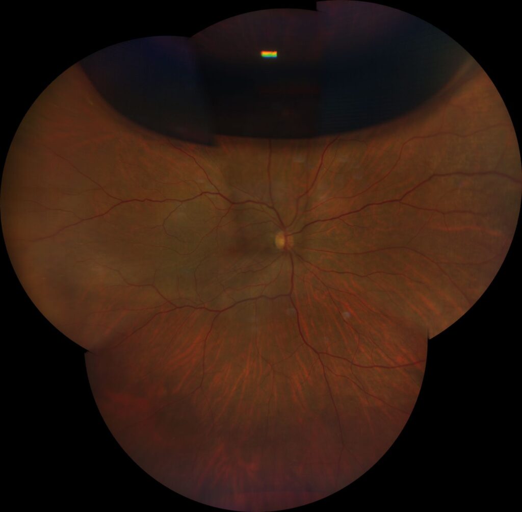 Retina após retinopexia pneumática mostrando reabsorção do gás e reaplicação da retina. Exame ilustrativo do Dr. Paulo Oliveira, especialista em retina e vítreo em Goiânia (GO).