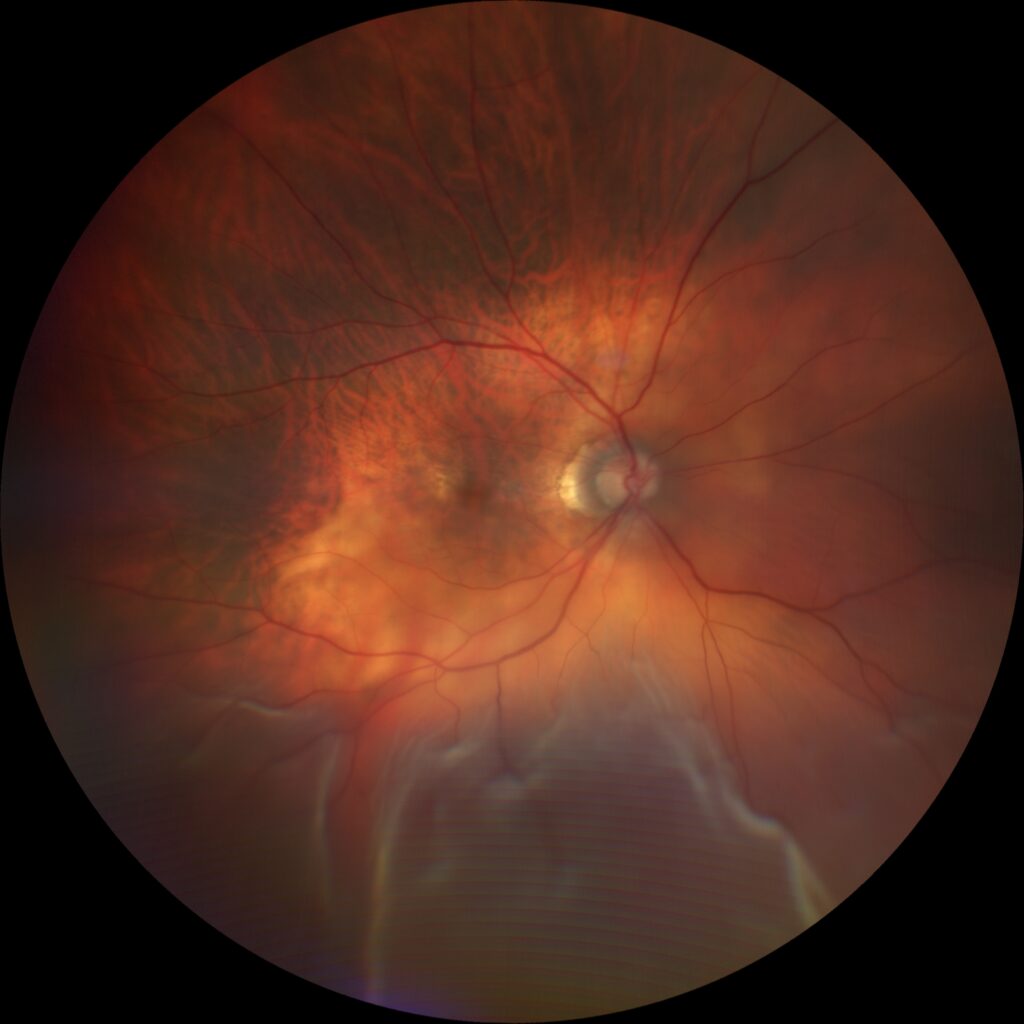 Imagem de fundo de olho mostrando descolamento de retina. Exame ilustrativo do Dr. Paulo Oliveira, especialista em retina e vítreo em Goiânia
