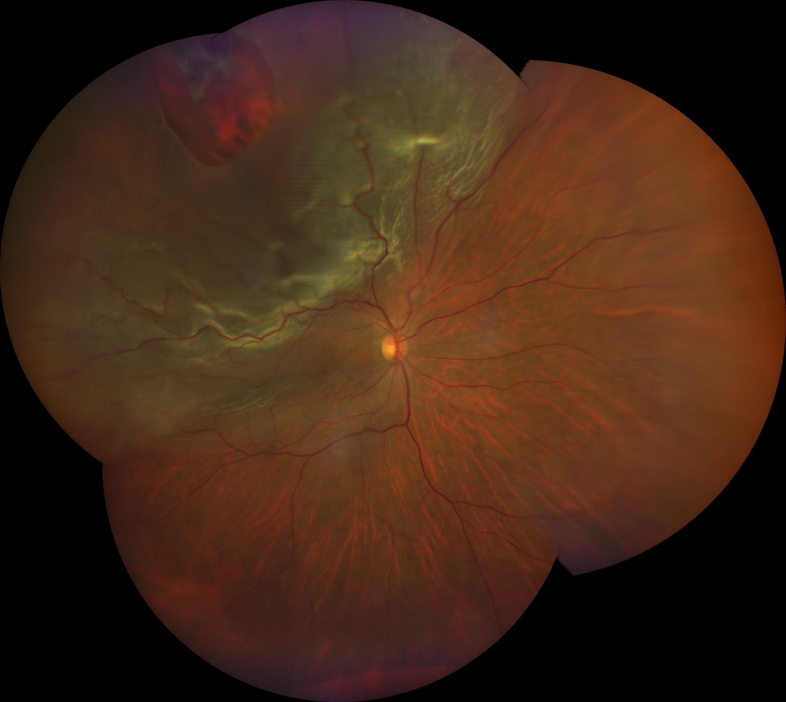 Retinografia mostrando descolamento de retina